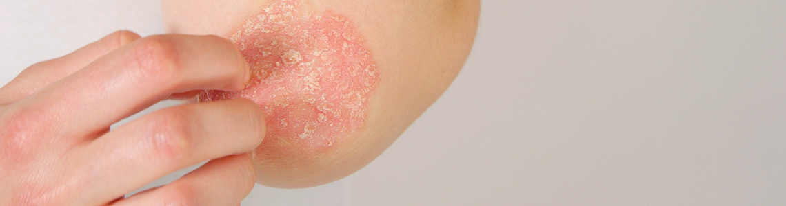 What is Dermatitis? hero image